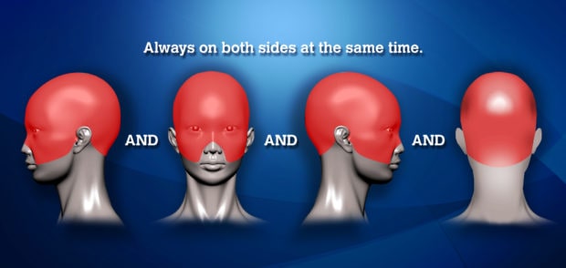 Types of Headaches & Headache Location Chart | Virtual Headache Specialist