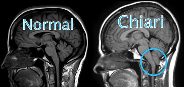 chiari-malformation-headache-and-why-you-may-still-have-a-daily