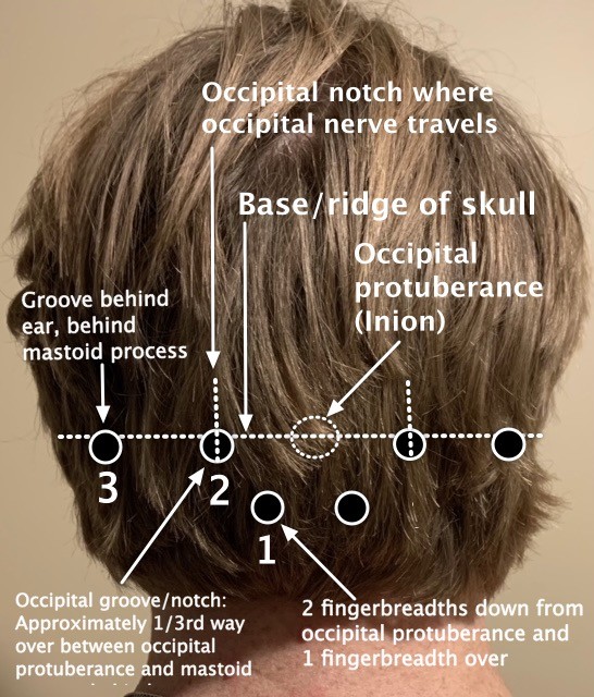 Occipital nerve block sites