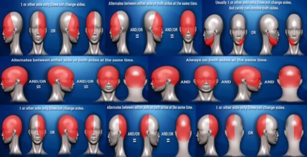 Types Of Headaches Headache Location Chart Virtual Headache Specialist