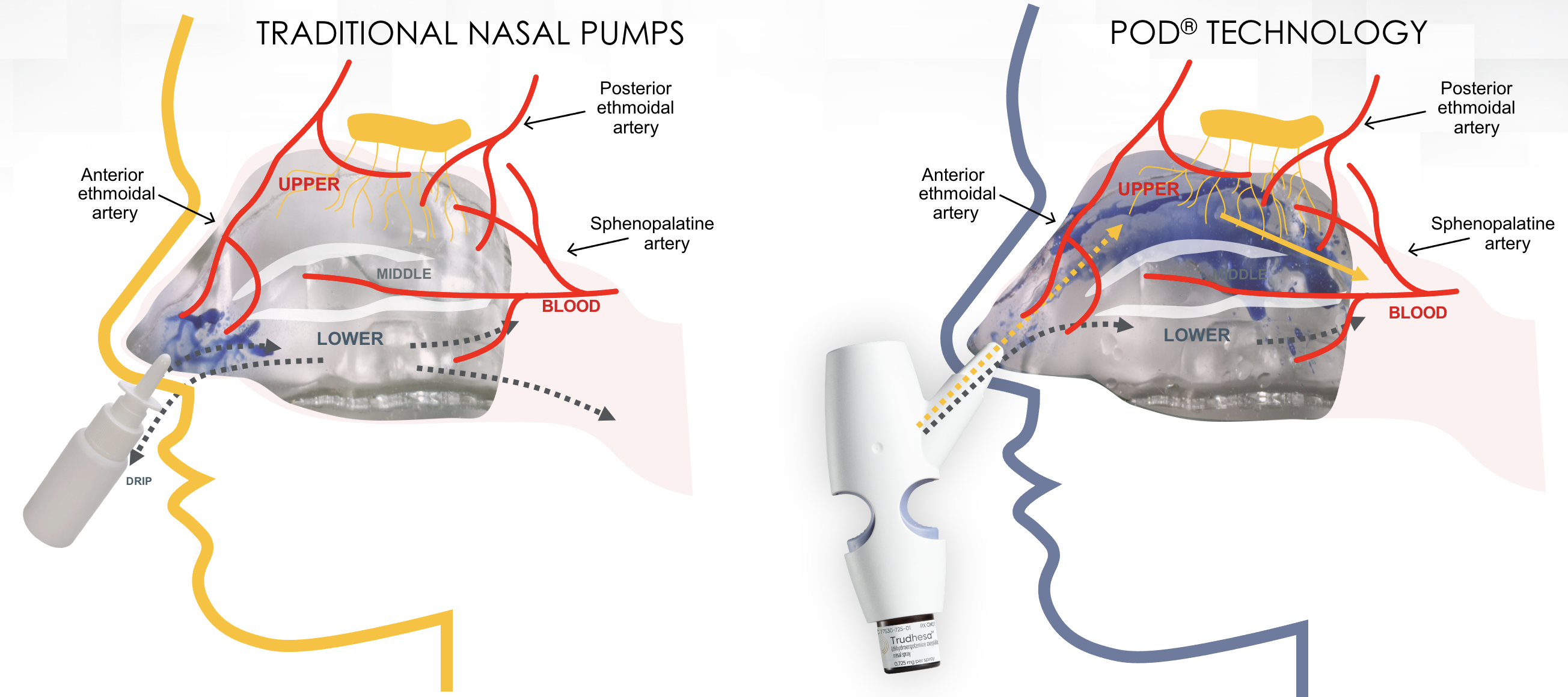 Nasal spray for sale headaches