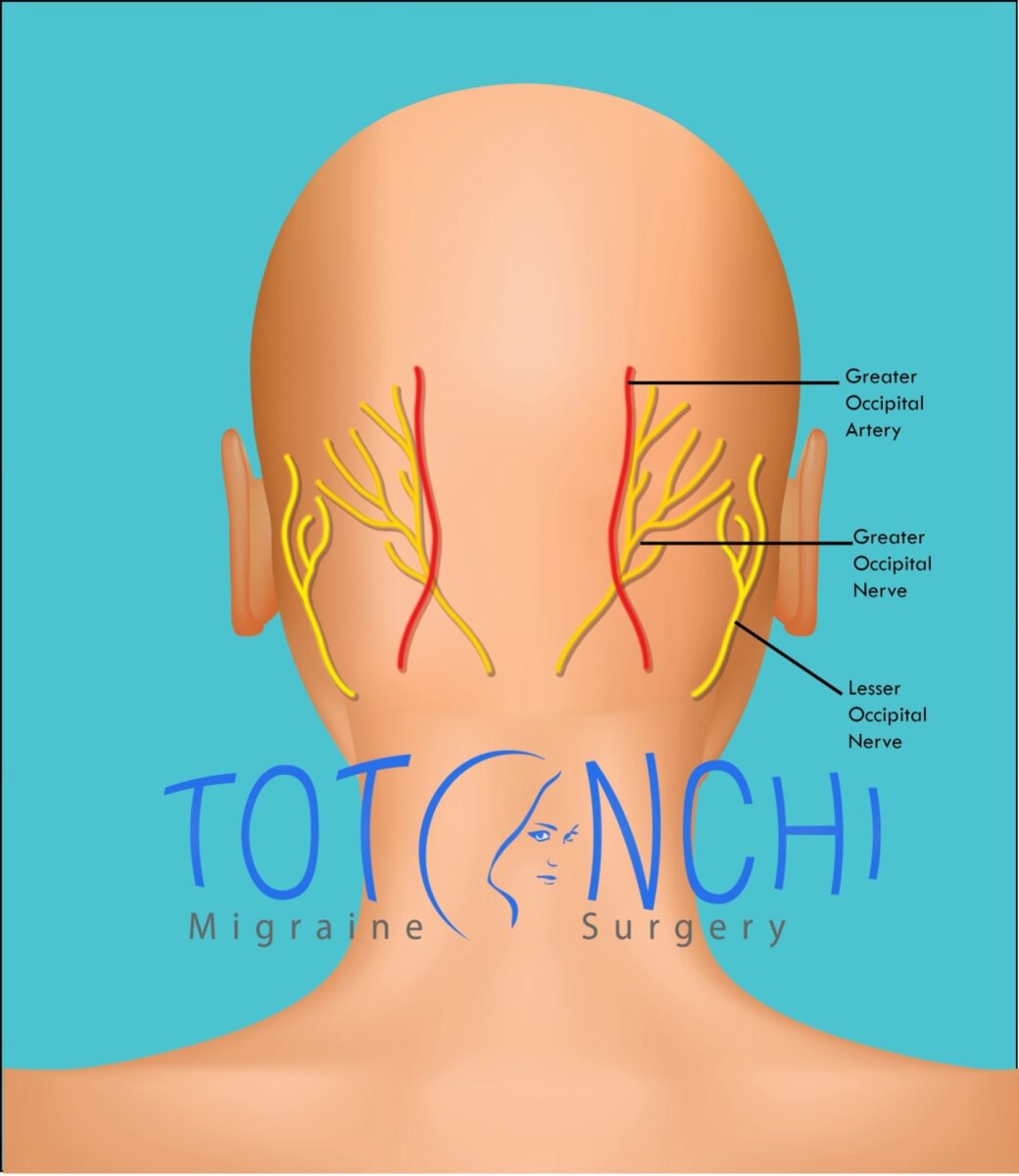 Occipital Nerve Decompression For Occipital Neuralgia Can It Bring