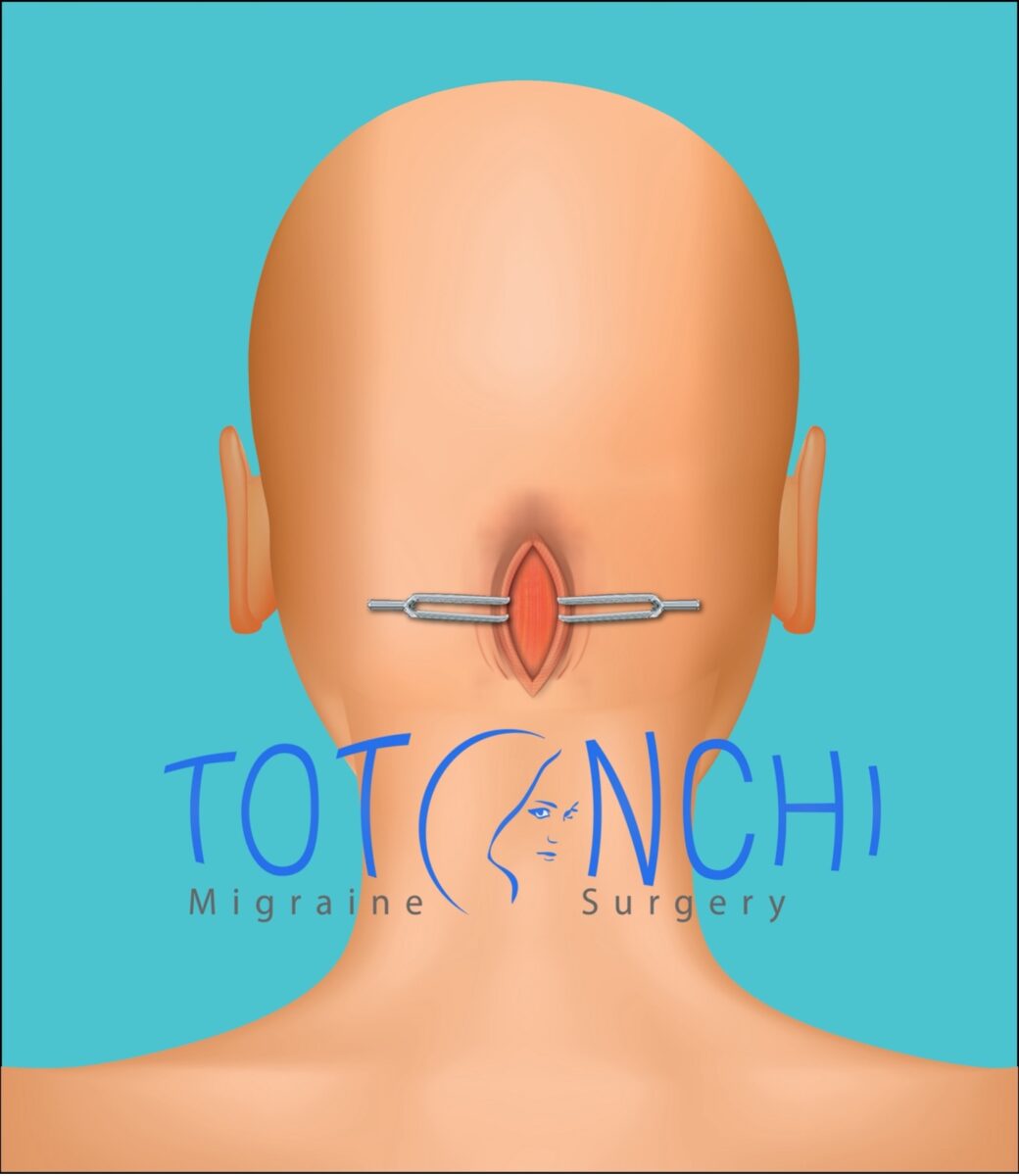 occipital nerve decompression