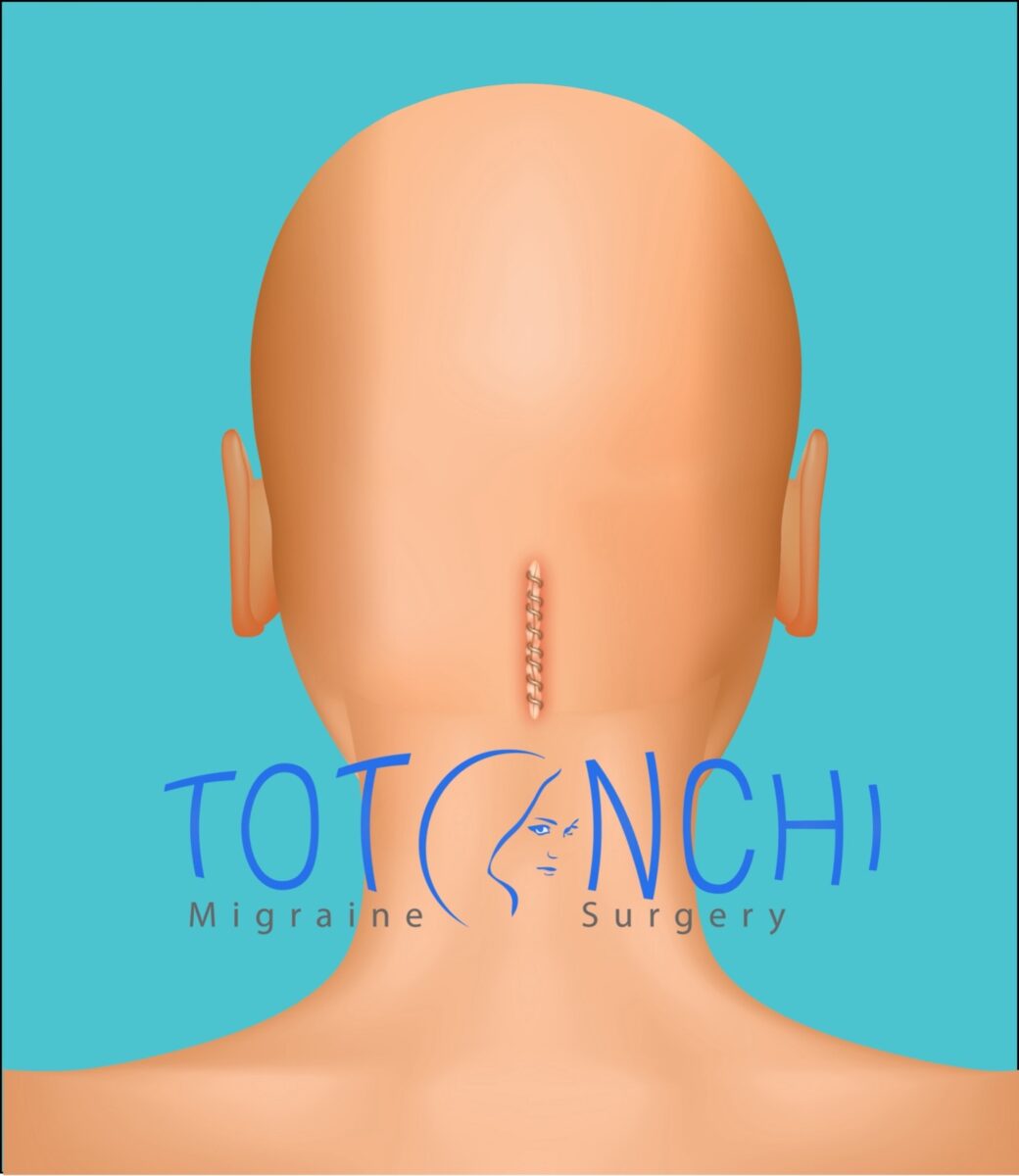 occipital nerve decompression