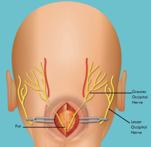 WHAT IS OCCIPITAL NERVE DECOMPRESSION FOR OCCIPITAL NEURALGIA, AND CAN IT HELP YOU?