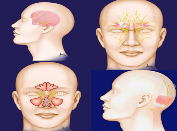 THE SURGICAL TREATMENT OF MIGRAINE HEADACHES (MIGRAINE SURGERY). HOW ...