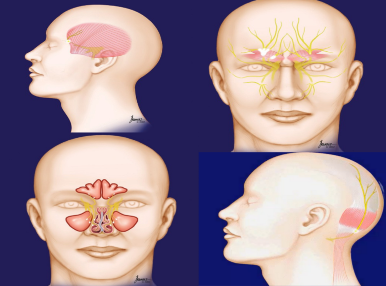 Occipital Nerve Decompression Virtual Headache Specialist