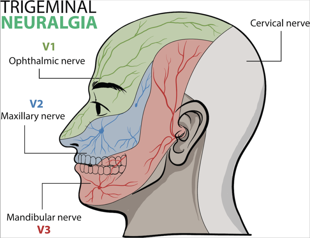Trigeminal Neuralgia: Facial Pain Symptoms and Treatments - Virtual ...
