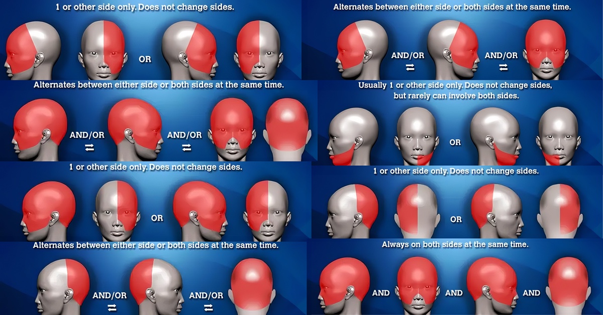 Headache chart and headache locations for different types of headaches. Headache map for location of headache meaning.